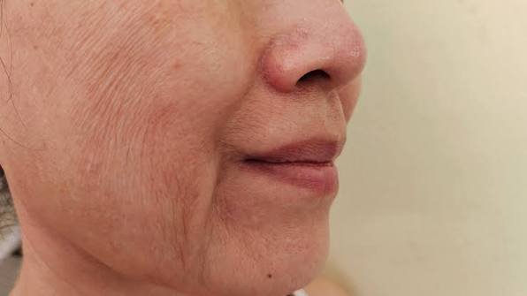 Aging, Fine Lines & Loss of Elasticity