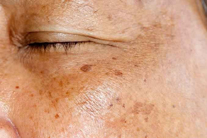 Hyperpigmentation & Dark Spots