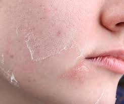 dry skin
