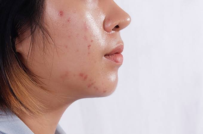  Oily & Acne-Prone Skin