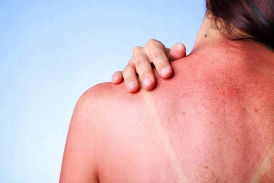 How to Treat Sunburn Fast: 5 Doctor-Approved Steps & Relief