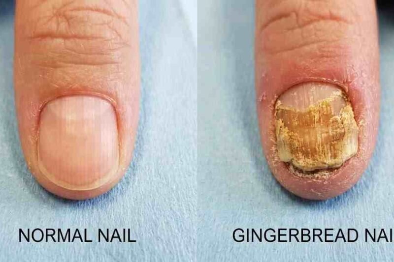 gingerbread nails disease