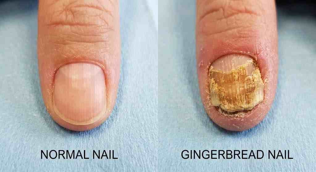 gingerbread nails disease