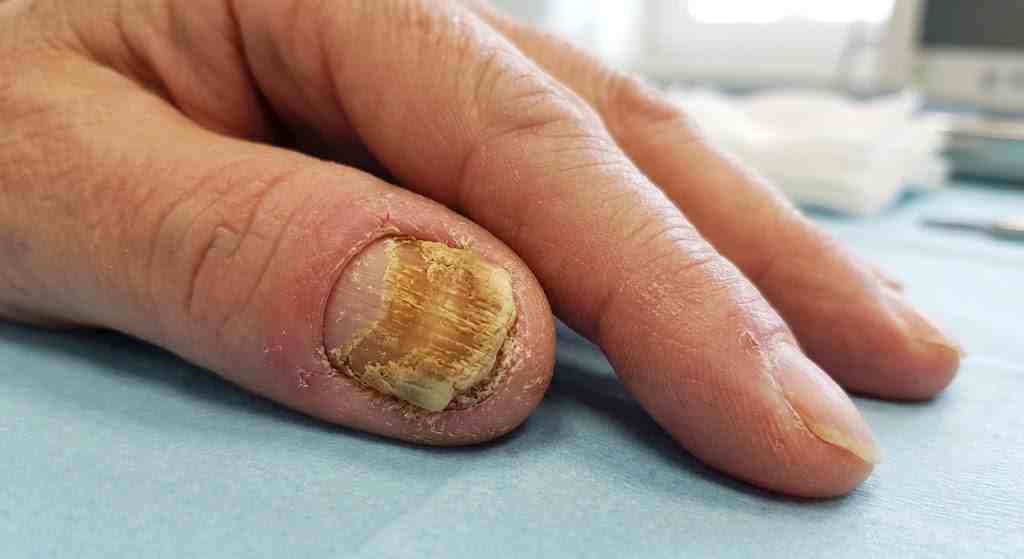 gingerbread nails disease